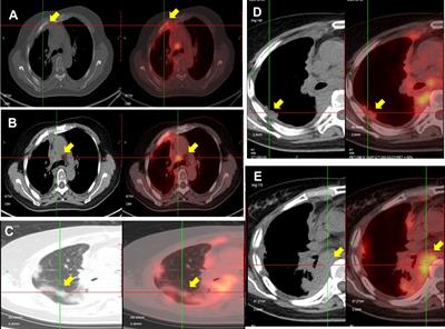 Case report and literature review: thyroid carcinoma showing intrathyroid thymic carcinoma